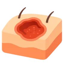 Cutaneous Amebiasis