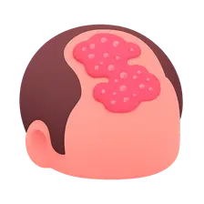 Scalp Psoriasis