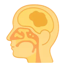 Complications of Sinusitis