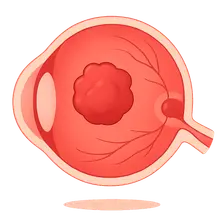 Retinal Tumors