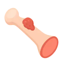 Amputation for Bone Tumors