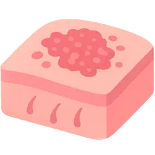 Psoriasis Vulgaris