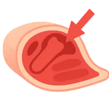Compartment syndrome pathophysiology