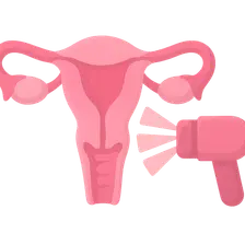 Radiation Therapy in Gynecologic Malignancies