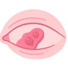 Degenerations of Conjunctiva