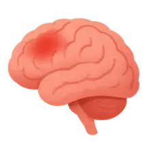 Neuroleptic Malignant Syndrome