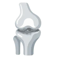 Osteoarthritis: Pathophysiology
