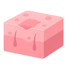 Acne Scarring and Its Management