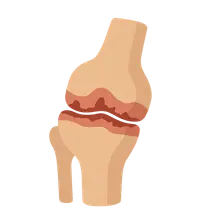 Osteoarthritis