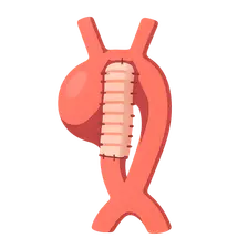 Thoracic aortic aneurysm management