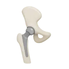 Joint replacement basics (hip