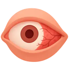Episcleritis