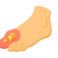 Crystal arthropathies (gout, pseudogout)