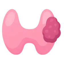 Thyroid neoplasms