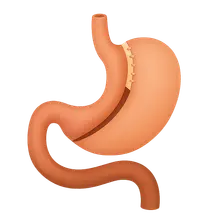 Malabsorptive Procedures