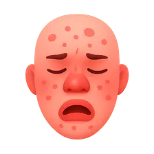 Anaphylaxis and Allergic Reactions