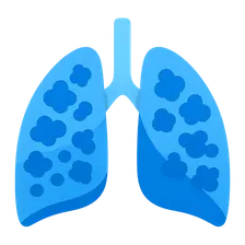 Hypersensitivity pneumonitis