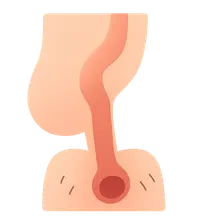 Anorectal Malformations