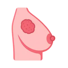 Breast cancer staging and surgical management