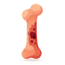 Osteomyelitis