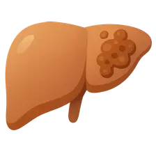 Drug-induced liver injury