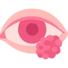 Benign Tumors of Conjunctiva
