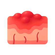 Chronic inflammation