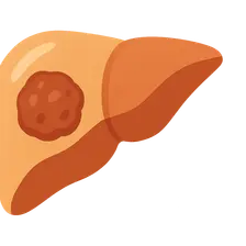 Hepatocellular carcinoma