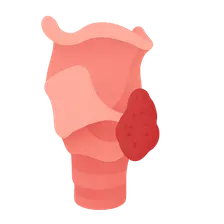 Hypopharyngeal Carcinoma
