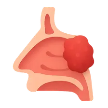 Sinonasal Malignancies