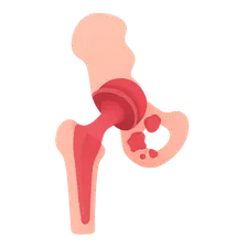 Prosthetic Joint Infections