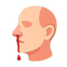 Epistaxis