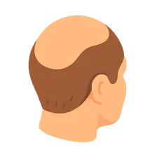 Androgenetic Alopecia