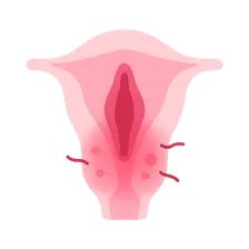 Vulvovaginitis