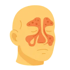 Acute Rhinosinusitis