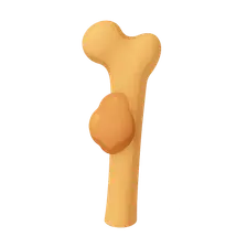 Benign Bone Tumors