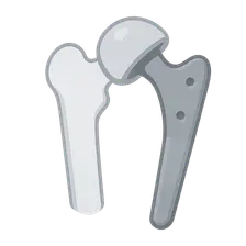 Principles of Joint Replacement