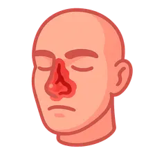 Nasal Trauma