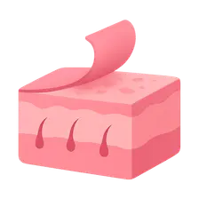 Chemical Peels