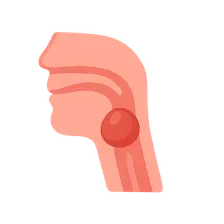 Retropharyngeal Abscess