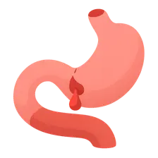 Anastomotic leak