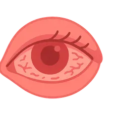 Conjunctivitis: Viral