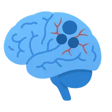 Vascular dementia