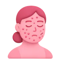 Acne in Special Populations