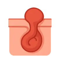 Incarcerated/strangulated hernias