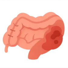Necrotizing enterocolitis surgical management