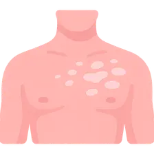 Pityriasis Alba