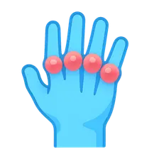 Rheumatoid Arthritis