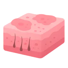 Mixed Connective Tissue Disease