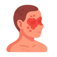 Lupus Erythematosus: Systemic with Skin Manifestations